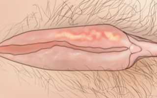 Герпес на половых губах — стоит ли бояться и как с этим справиться?