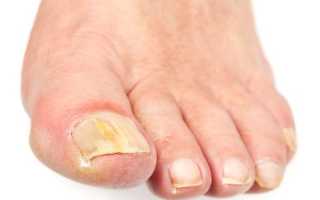 Причины желтых ногтей на ногах и их лечение
