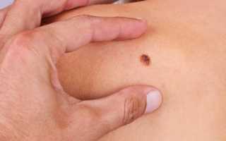 Как выглядит меланома кожи на лице