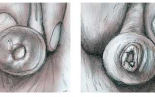 Почему болит головка члена? Узнайте причины и решения