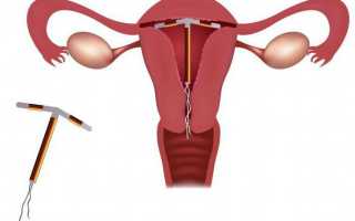 Маточная спираль мирена