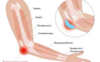 Бурсит суставов