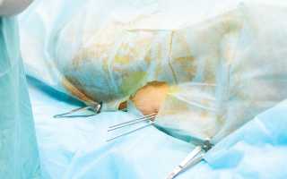 Операция при переломе шейки бедра