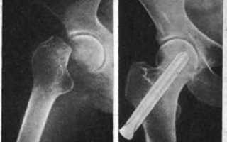 Консолидированный перелом