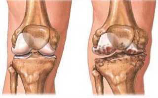 Артроз коленного сустава 1 степени