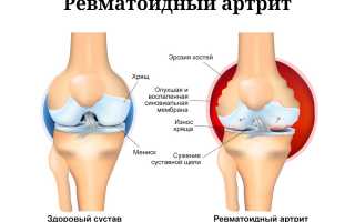 Ревматоидный артроз