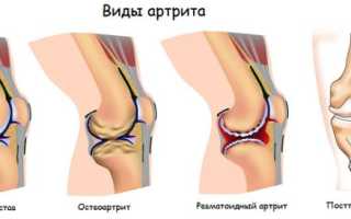 Периартрит коленного сустава симптомы и лечение