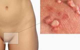 Папилломы во влагалище: причины и лечение