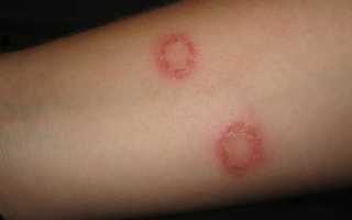 Как выглядит лишай у человека на начальной стадии: признаки и симптомы