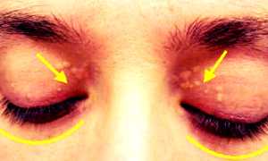 Ксантелазма и проявление бляшек на коже