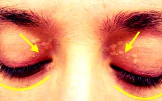 Ксантелазма и проявление бляшек на коже