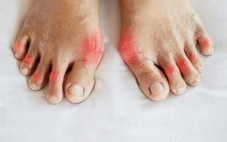 Лечение подагры на большом пальце ноги