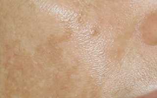 Коричневые пятна на коже: причины и лечение