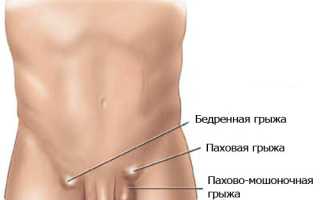 Почему появляются шарики в паху у женщин и мужчин: причины и последствия