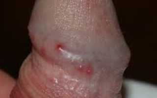 Почему возникает аллергия на половом члене и что делать мужчинам для улучшения здоровья