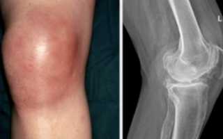 Артрит коленного сустава
