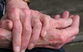 Причины почему кожа на руках сохнет и трескается? Узнайте больше о проблеме