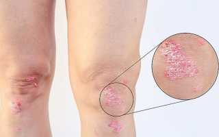 Псориатический артрит