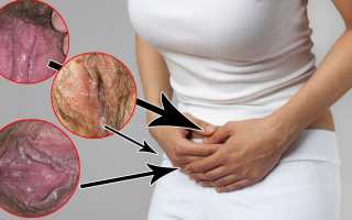 Генитальный кандидоз: причины и лечение