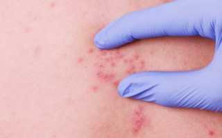 Сыпь на спине и животе у ребенка: причины и лечение