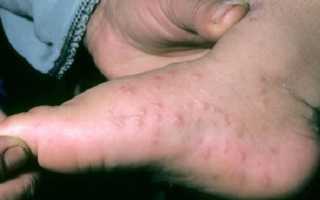 Эпидермофития стопы — что это такое, какие симптомы и лечение, особенности и профилактика