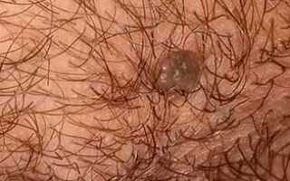 Папилломы на лобке: причины и лечение