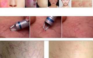 Как быстро убрать сосудистые звездочки на лице? Полезные советы и рекомендации