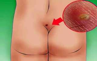 Все про прыщи на анусе: причины и лечение