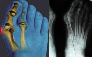 Деформирующий остеоартроз