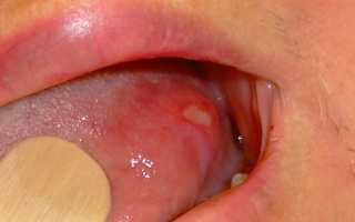 Причины почему появляются язвы на языке и их последствия