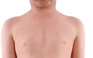 При каких болезнях мелкая сыпь на теле у ребенка может возникать?