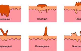Причины появления папиллом на шее и методы лечения для здоровья