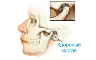 Артрит челюстного сустава