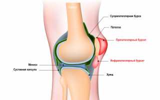 Бурсит коленного сустава