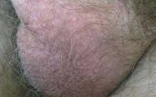 Почему появилось покраснение яичек? Причины и советы