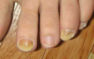Изменение ногтевой пластины на ногах причины