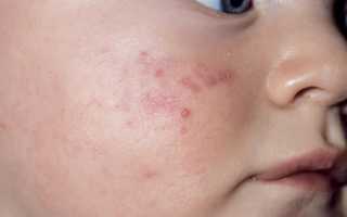 Сыпь на теле у ребенка: причины и лечение