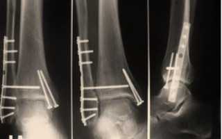Операция при переломе лодыжки