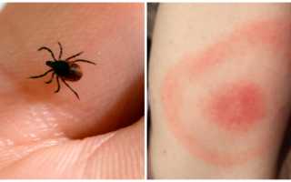 Пятна после укусов клеща: причины и лечение