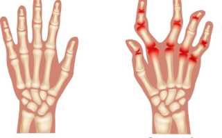 Ревматоидный полиартрит