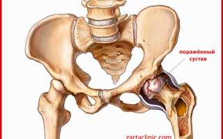 Коксартроз