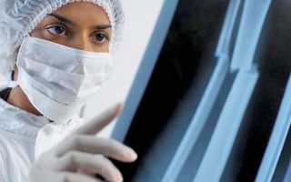 Неправильно сросшийся перелом