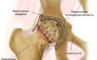 Артрит тазобедренного сустава