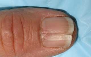 Черные полоски на ногтях: причины и лечение