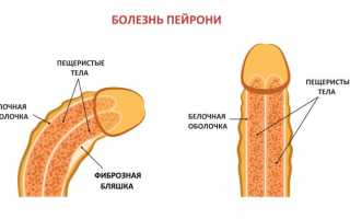 Заболевания головки у мужчин
