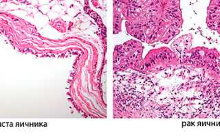 Может ли эндометриоидная киста перерасти в рак