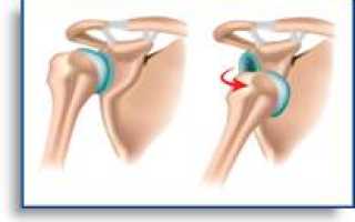 Привычный вывих плеча