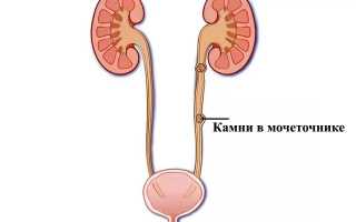 Камни в мочеточнике