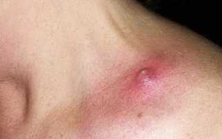 Лечение фурункула в домашних условиях: советы и рекомендации