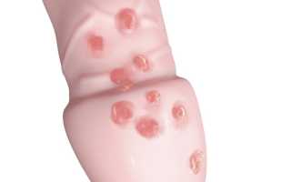 Что делать если появились красные пятна на головке члена: советы и рекомендации